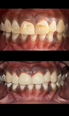Before and after: chipped and stained front teeth above, and the teeth after treatment below