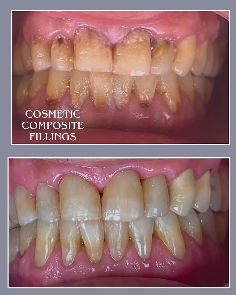 Before and after: stained and worn front teeth above, and the teeth after cosmetic composite fillings below