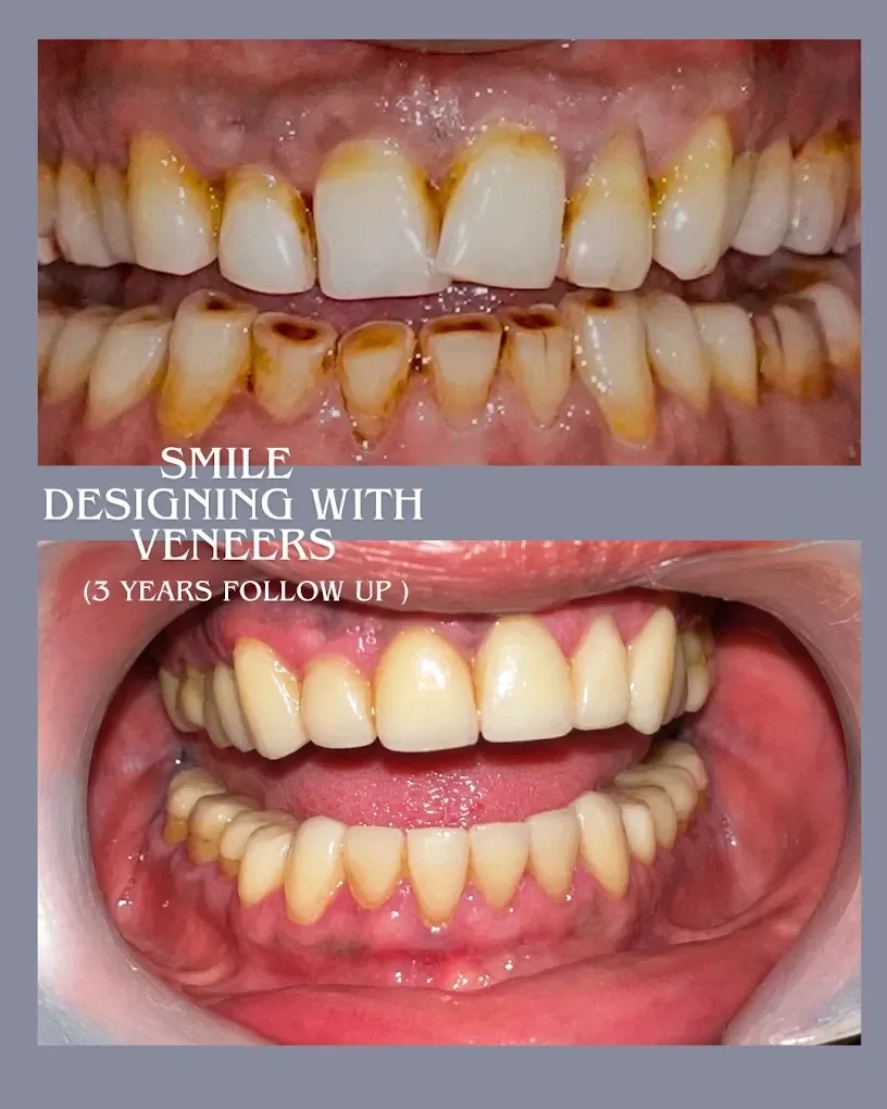 Before and after: front teeth with heavy staining above, and the same teeth after smile designing with veneers at three years follow-up below